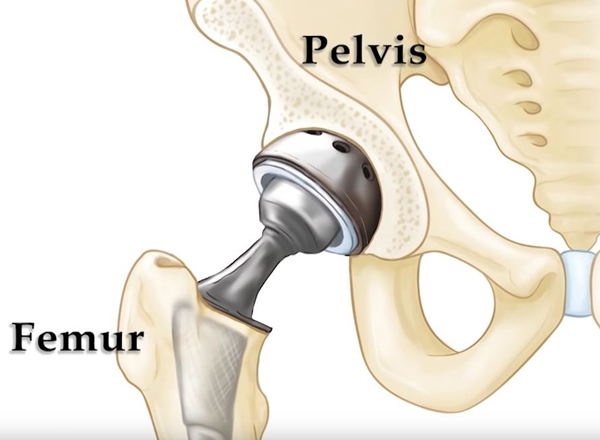 Hip Arthroscopy  in Vaishali nagar Jaipur