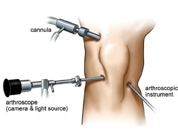 Knee Replacement  in Vaishali nagar Jaipur
