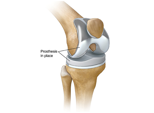 Knee Replacement  in Vaishali nagar Jaipur
