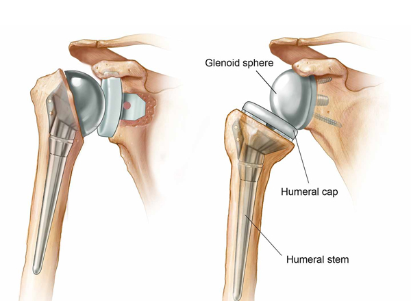 Shoulder Replacement  in Vaishali nagar Jaipur